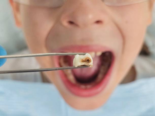 Best Broken or Cracked Tooth Emergency Dentist in North Branch, MI